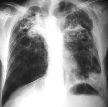 Tuberculosis torrente.jpg